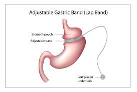 after gastric band surgery