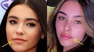 madison beer before surgery what you