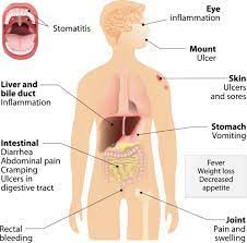 crohn s disease and ulcerative colitis