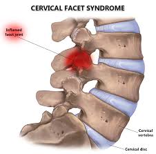 cervical facet syndrome nj nyc