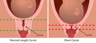 cervix incompetent effaced short