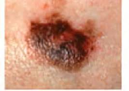 New moles appear during childhood and adolescence. Melanoma Warning Signs And Images The Skin Cancer Foundation