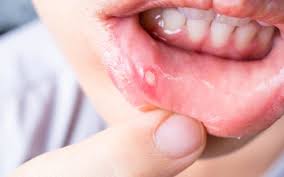 canker cold sores dr soon