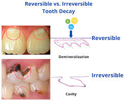 can you actually reverse tooth decay