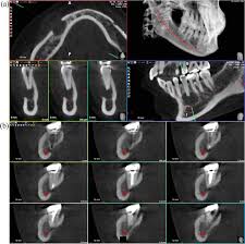 s of cbct in endodontics