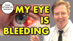how to treat broken blood vessel in eye