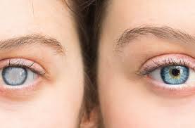 between cataract surgery on each eye