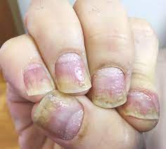 pitted nails as sign of psoriasis