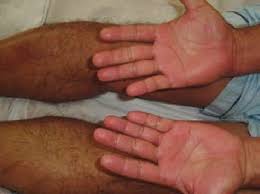 Red palms or palmar erythema can be classified into two types as per the causes. Case 4 Photograph Shows Bilateral Palmar Erythema Download Scientific Diagram