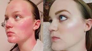 masterfully covered her sunburn with makeup