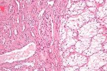 Image result for icd 10 code for personal history of renal cell cancer