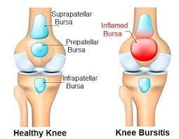 knee bursitis symptoms diagnosis