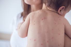 diaper rash to kids eczema when to