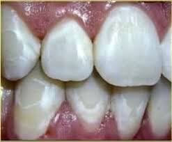 Baking soda is an abrasive that perfectly removes plaque, but damages the enamel. How To Whiten Teeth W Braces I Ve Used Mouthwashes Flossed Baking Soda Cleaning Brushed 2x A Day Quora