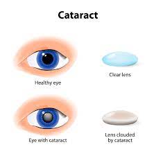 cataract surgery in kansas city mo