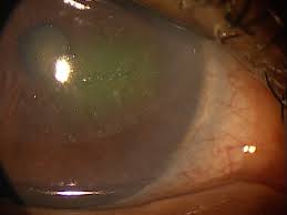 h18 59 anterior corneal dystrophies