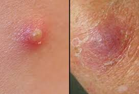 Ingrown hair can cause painful lump in armpit in male. Boils Pictures Causes Symptoms And Treatment