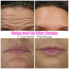 botox and lip filler transformation