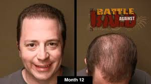 bosley hair transplant results after 12