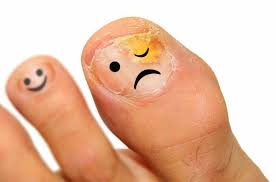 toenail fungus infection