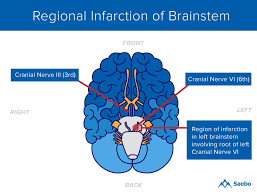 What Is A Brainstem Stroke Saebo