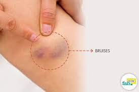 bruises fast with home remes