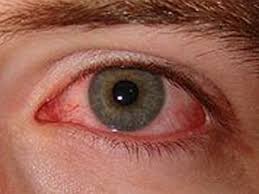 Resultado de imagen para conjuntivitis