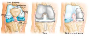 muskegon surgery center partial knee