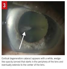 The Aging Crystalline Lens A Review Of Cataracts