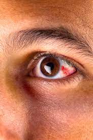 broken blood vessel in the eye