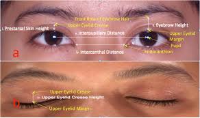 the prevalence of double eyelid and the