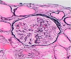 Atypical Anti Gbm Nephritis