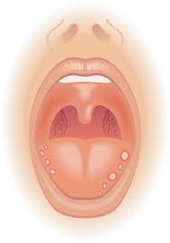 mouth ulcer pictures causes symptoms