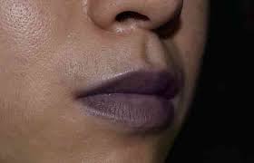 cyanosis skin discoloration causes