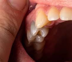 black teeth symptoms causes and