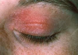 allergic reaction to cosmetic eye make