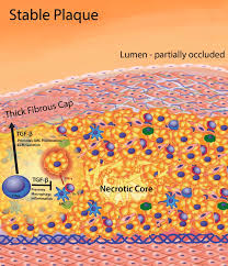 lipoproteins in atherosclerosis
