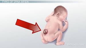 what is spina bifida definition
