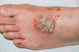 eczema blisters symptoms location