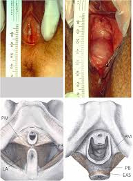 hiatal failure effects of pregnancy