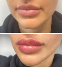 lip fillers and injections in los angeles
