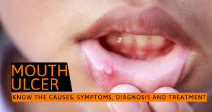 mouth ulcer know the causes symptoms
