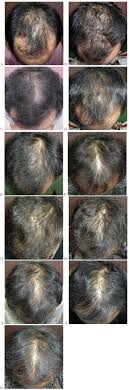 523 anese men with androgenetic alopecia