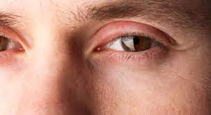swollen eyelids optometrist in