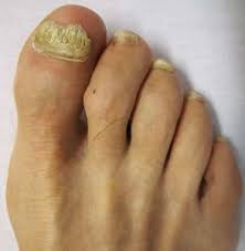 thick toenails in the elderly