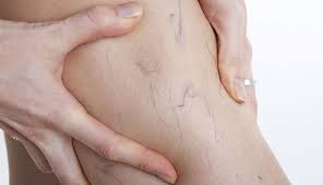 are painful spider veins dangerous