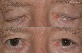 nerve palsy ocular