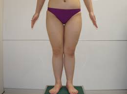 20歳女性 155㎝53㎏とても太い太ももをベイザーで美脚へ 1 ダウンタイム | シンシア～Sincerely Yours  銀座の美容外科・美容皮膚科（くま治療）