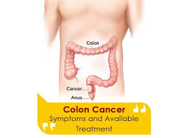 colorectal colon cancer treatment