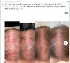 laser caps for hair growth do they